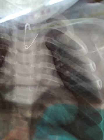 ​Κατάποση Ξένου σώματος